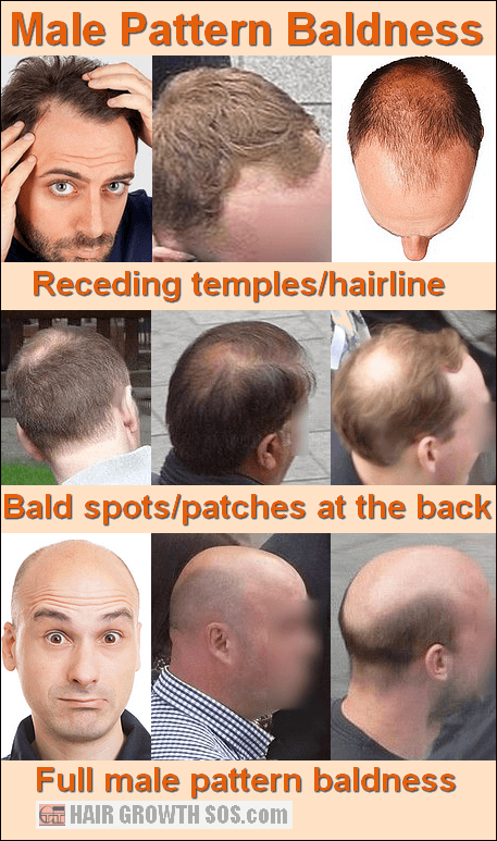 male-pattern-baldness-png.31088