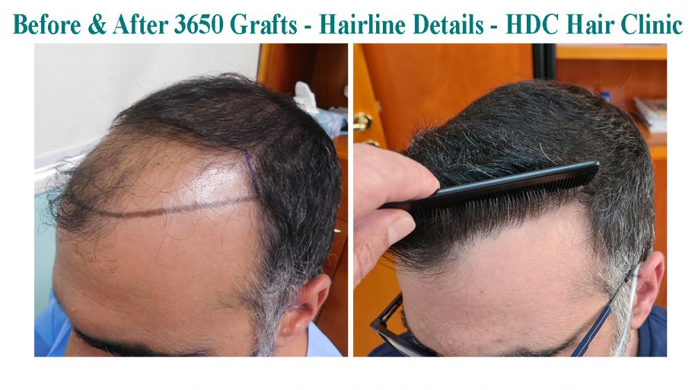 Medium Ellinas Set 2 for 3650 grafts HT 03-09-20.jpg