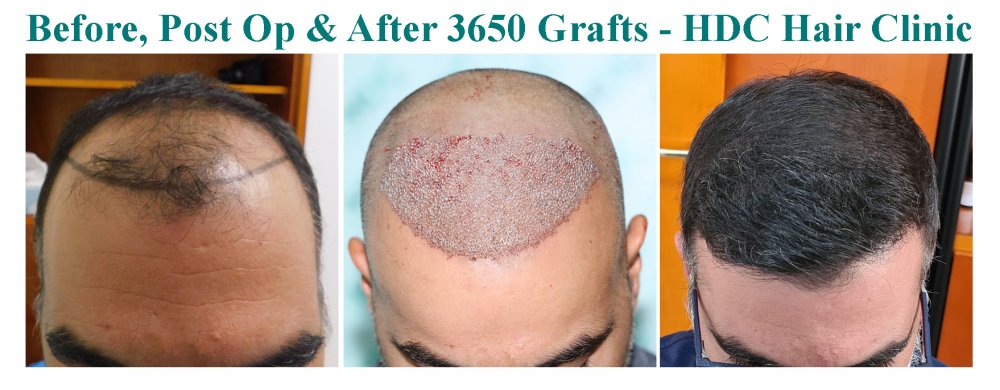 Medium Ellinas Set 3 for 3650 grafts HT 03-09-20.jpg