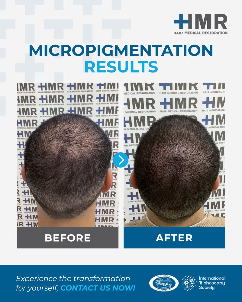 micropigmentation-before&after.jpeg