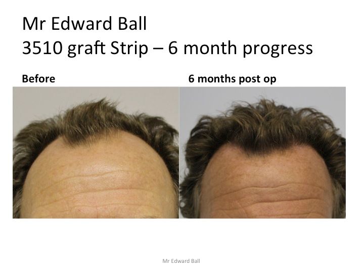 Mr Edward Maitland Ball Hair Restoration 1.jpg