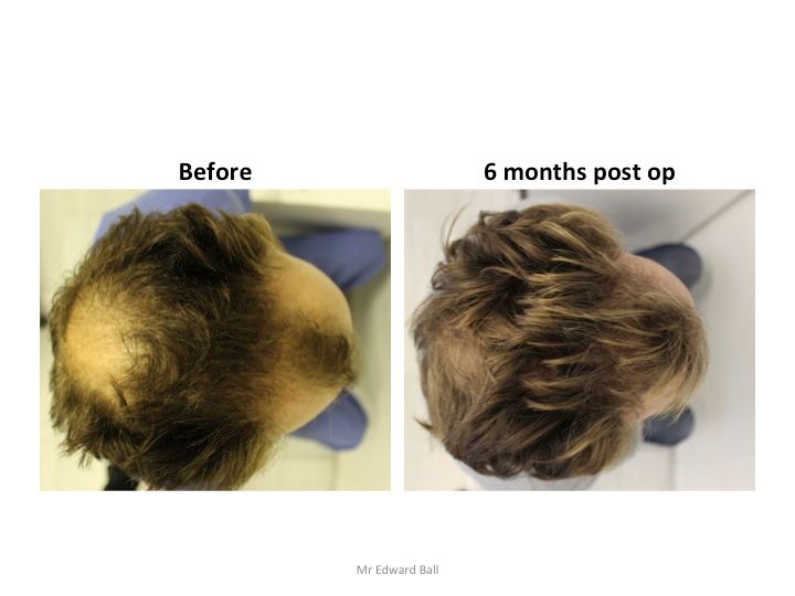 Mr Edward Maitland Ball Hair Restoration 10.jpg