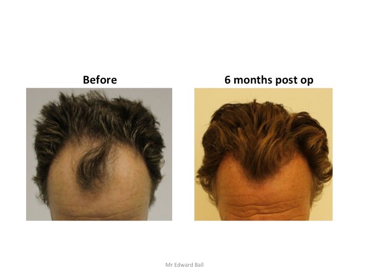 Mr Edward Maitland Ball Hair Restoration 2.jpg