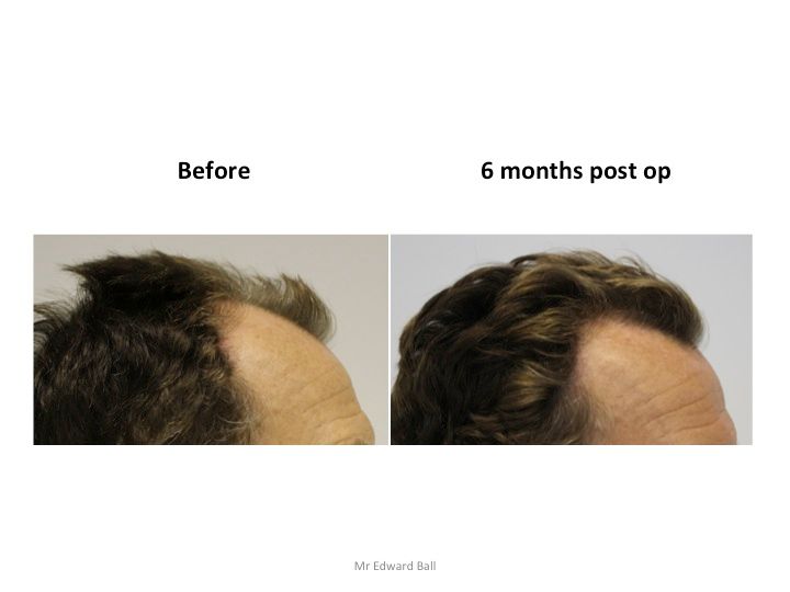 Mr Edward Maitland Ball Hair Restoration 3.jpg