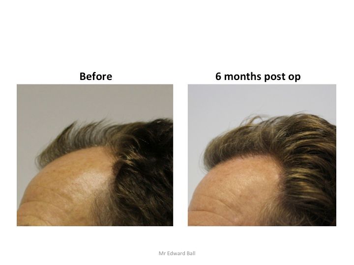 Mr Edward Maitland Ball Hair Restoration 4.jpg