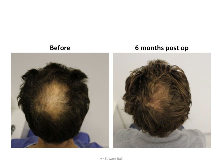 Mr Edward Maitland Ball Hair Restoration 5.jpg