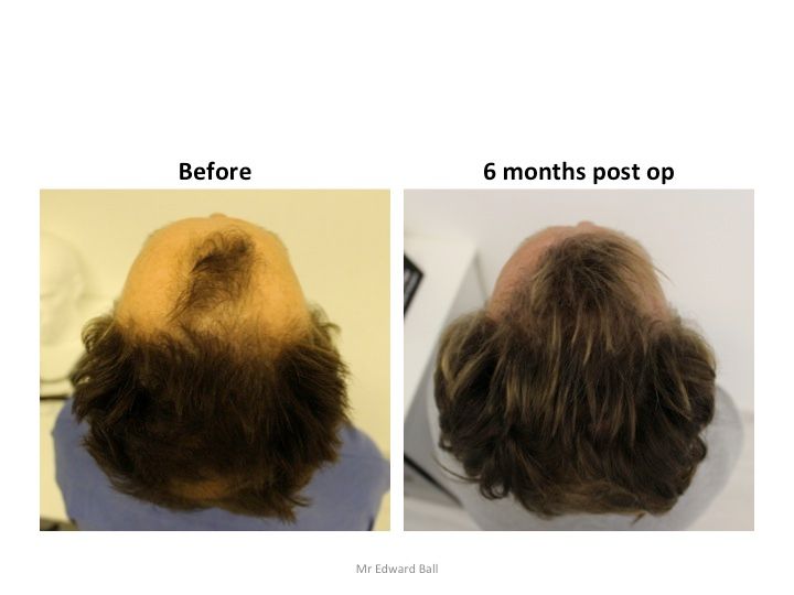 Mr Edward Maitland Ball Hair Restoration 6.jpg