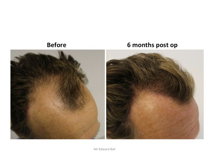 Mr Edward Maitland Ball Hair Restoration 7.jpg