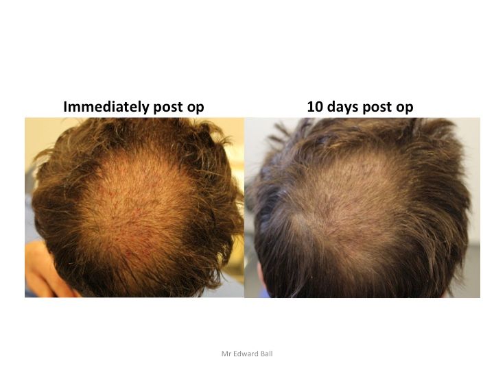 Mr Edward Maitland Ball Hair Restoration 8.jpg