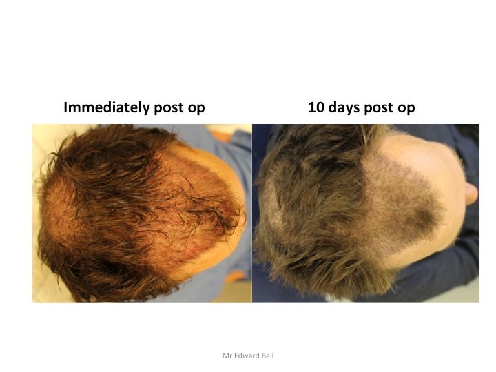 Mr Edward Maitland Ball Hair Restoration 9.jpg