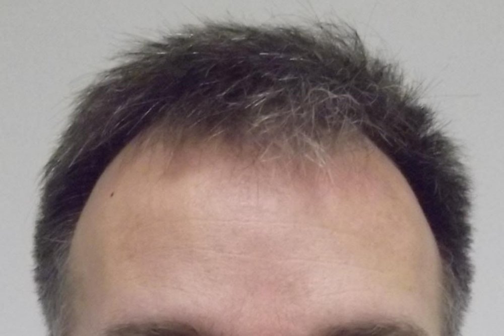 Mr. Edward Maitland Ball Hair Transplant 1.jpg