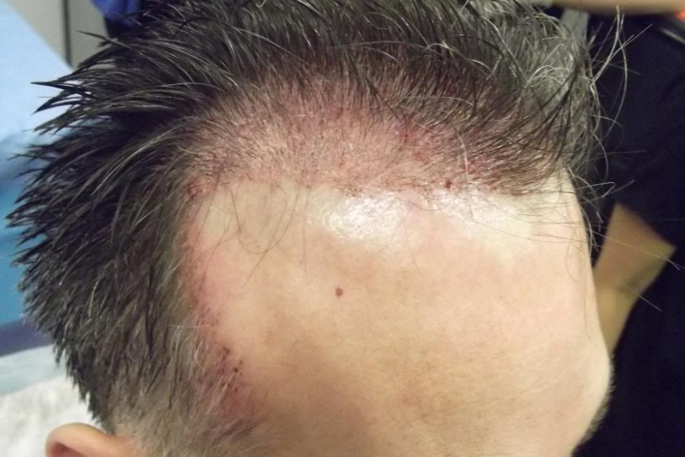 Mr. Edward Maitland Ball Hair Transplant 10.jpg