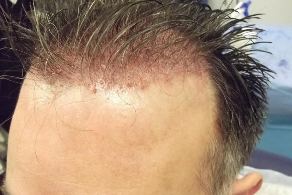 Mr. Edward Maitland Ball Hair Transplant 11.jpg