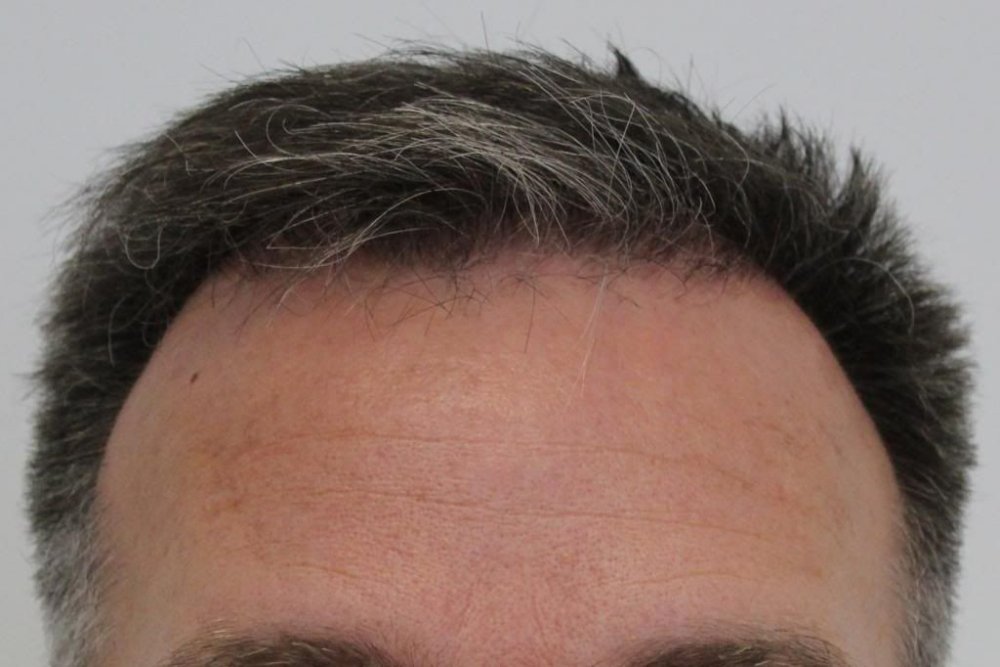 Mr. Edward Maitland Ball Hair Transplant 12.jpg