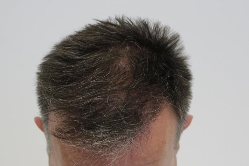 Mr. Edward Maitland Ball Hair Transplant 13.jpg