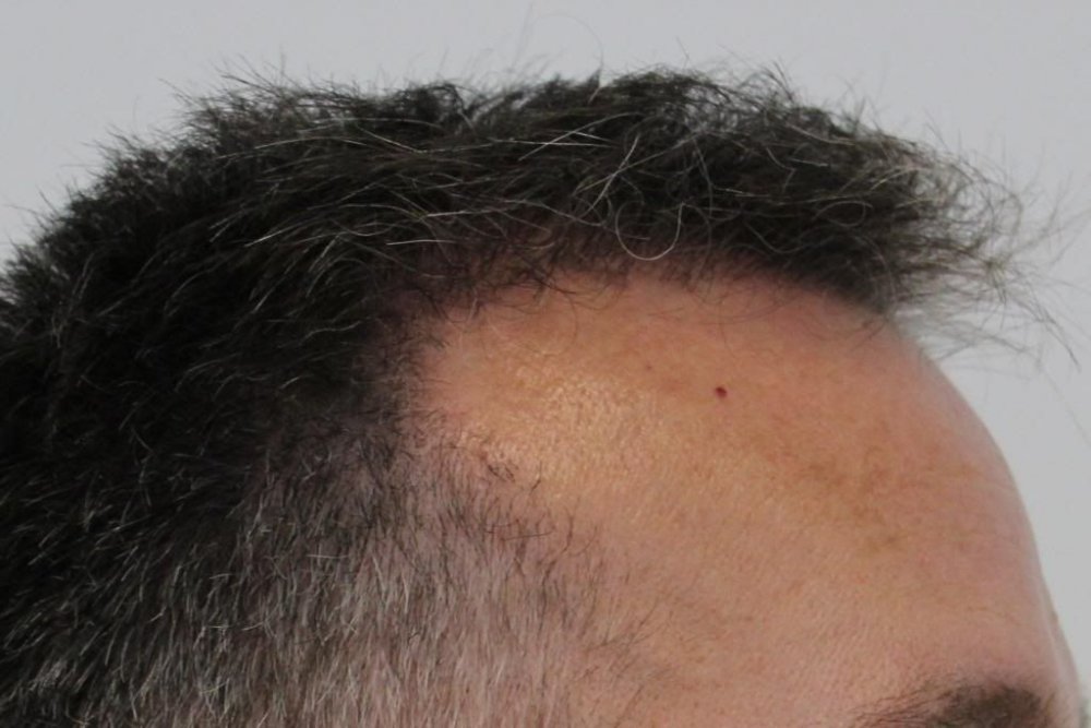 Mr. Edward Maitland Ball Hair Transplant 14.jpg