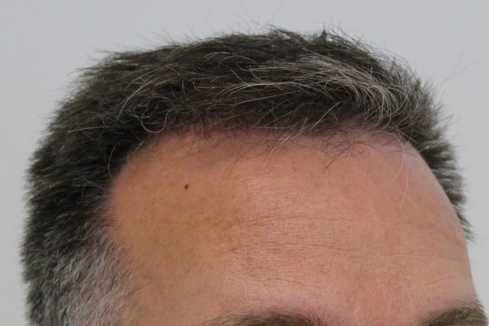 Mr. Edward Maitland Ball Hair Transplant 15.jpg