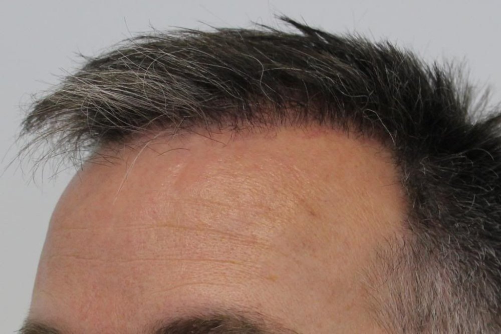Mr. Edward Maitland Ball Hair Transplant 16.jpg