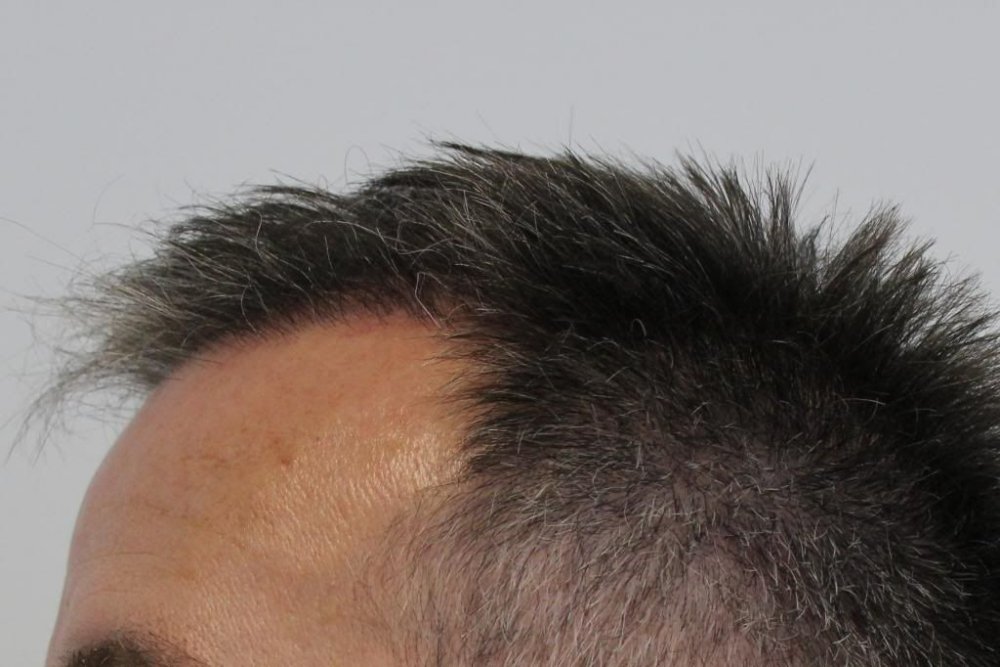 Mr. Edward Maitland Ball Hair Transplant 17.jpg
