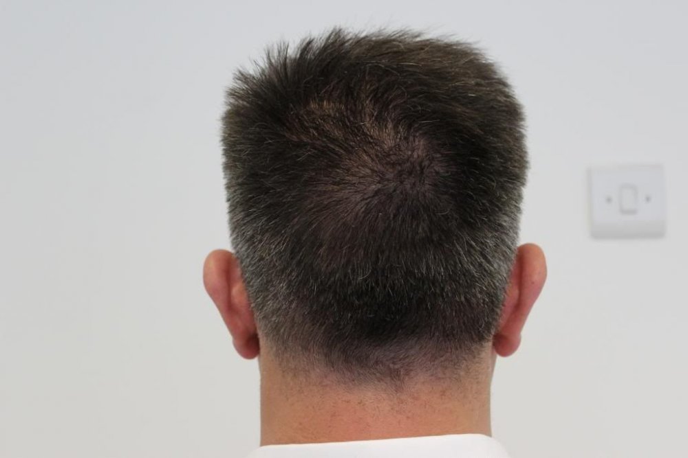 Mr. Edward Maitland Ball Hair Transplant 19.jpg