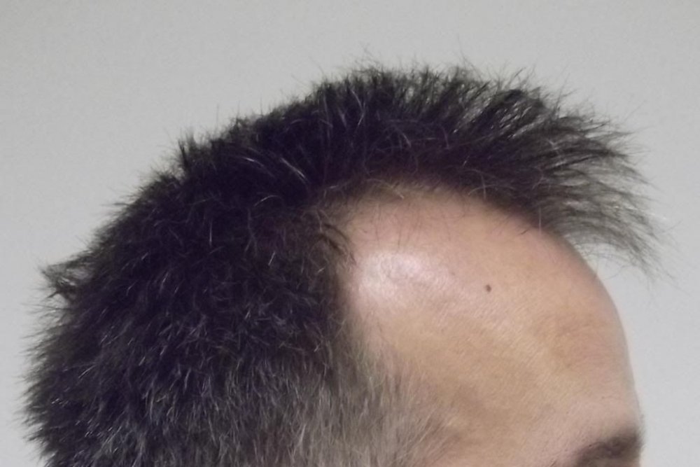 Mr. Edward Maitland Ball Hair Transplant 2.jpg
