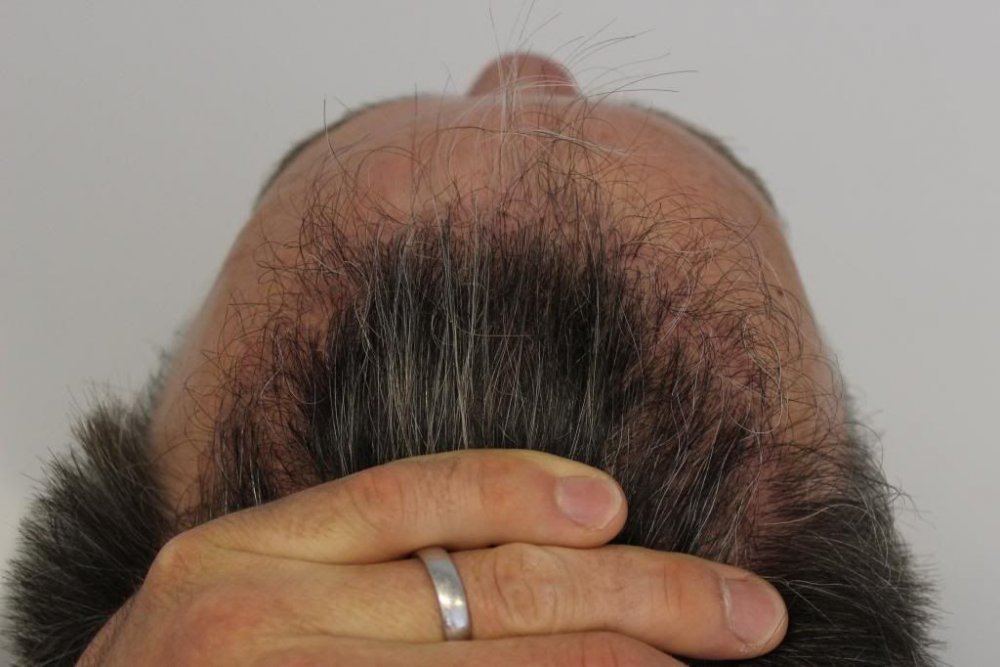 Mr. Edward Maitland Ball Hair Transplant 20.jpg
