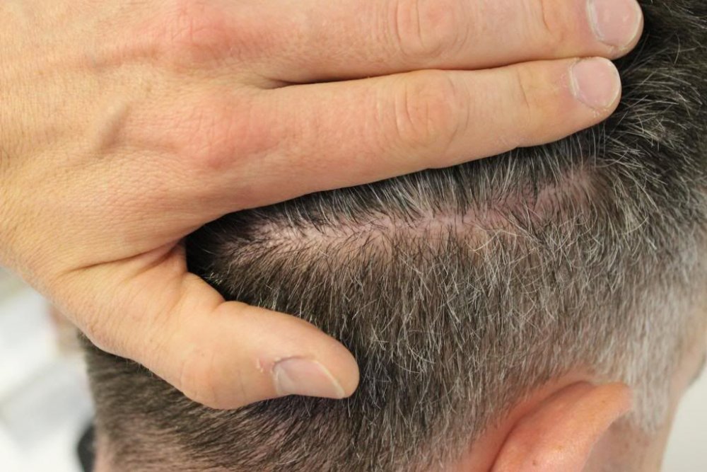 Mr. Edward Maitland Ball Hair Transplant 21.jpg