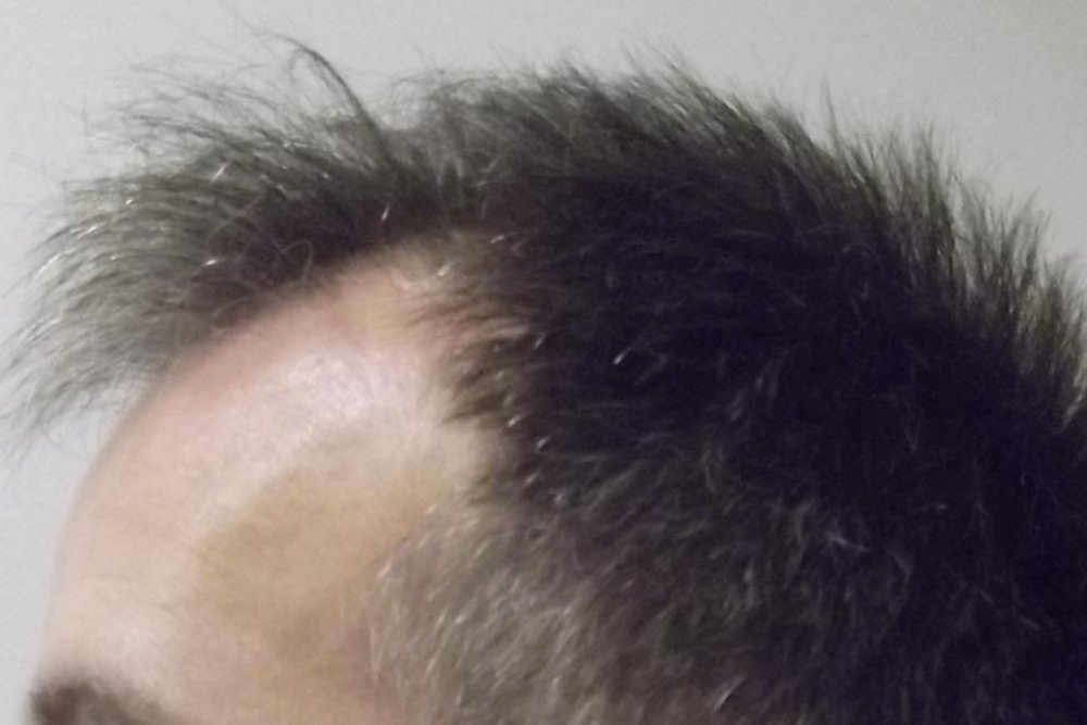 Mr. Edward Maitland Ball Hair Transplant 3.jpg