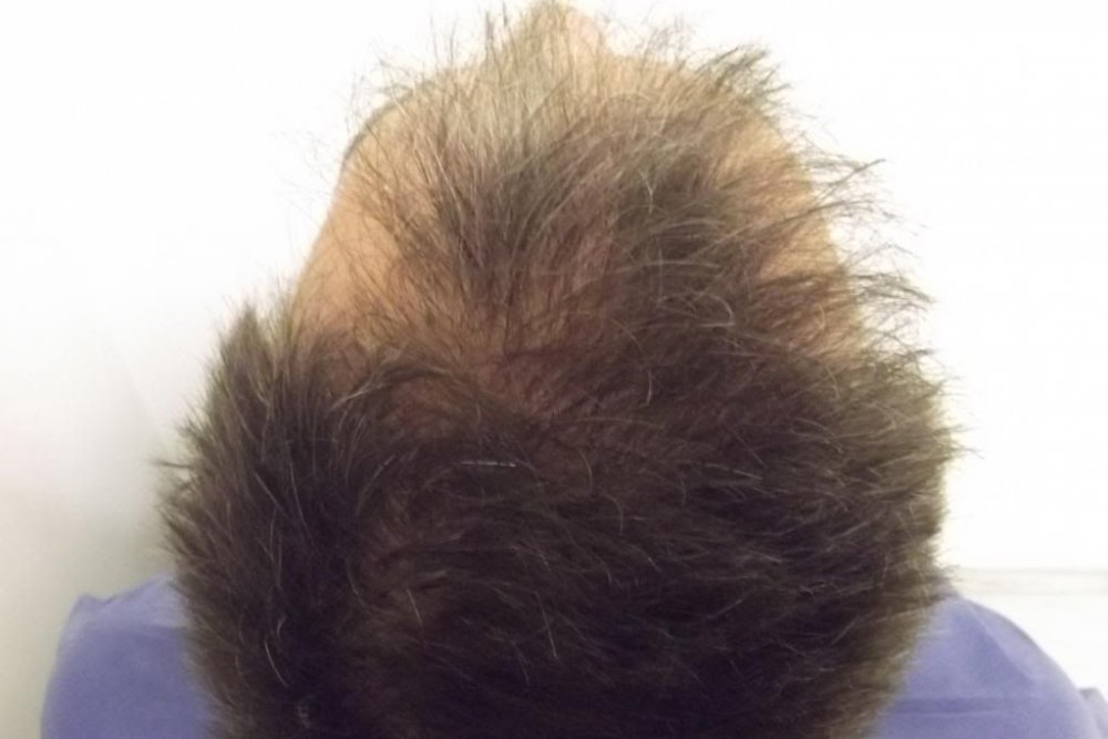 Mr. Edward Maitland Ball Hair Transplant 4.jpg