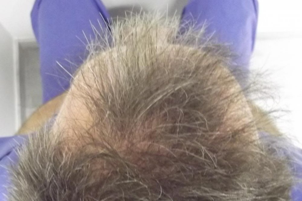 Mr. Edward Maitland Ball Hair Transplant 5.jpg