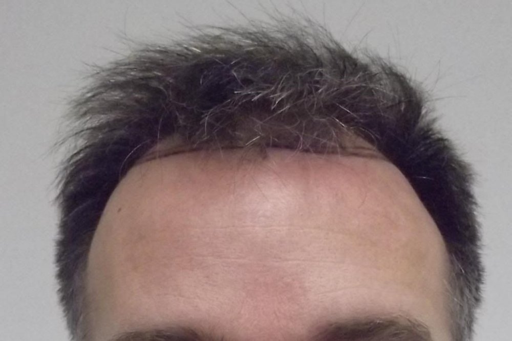 Mr. Edward Maitland Ball Hair Transplant 6.jpg