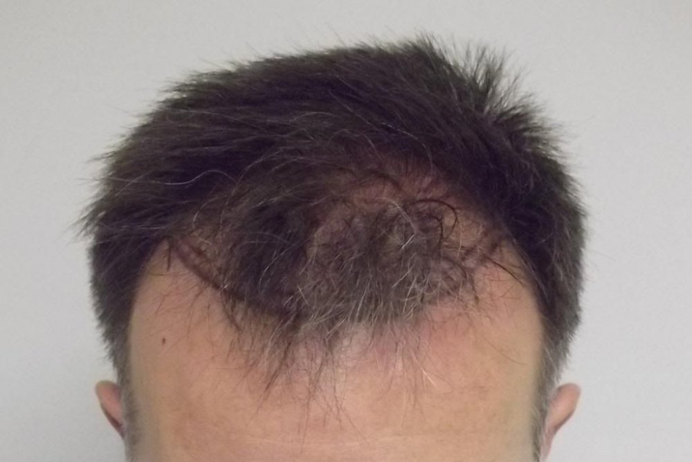 Mr. Edward Maitland Ball Hair Transplant 7.jpg