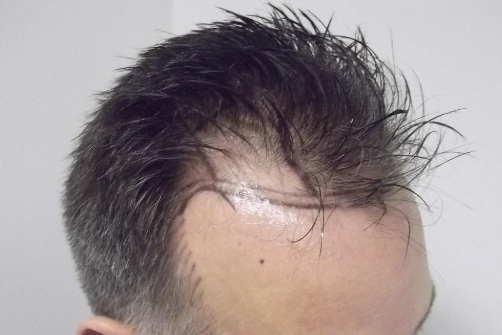 Mr. Edward Maitland Ball Hair Transplant 8.jpg
