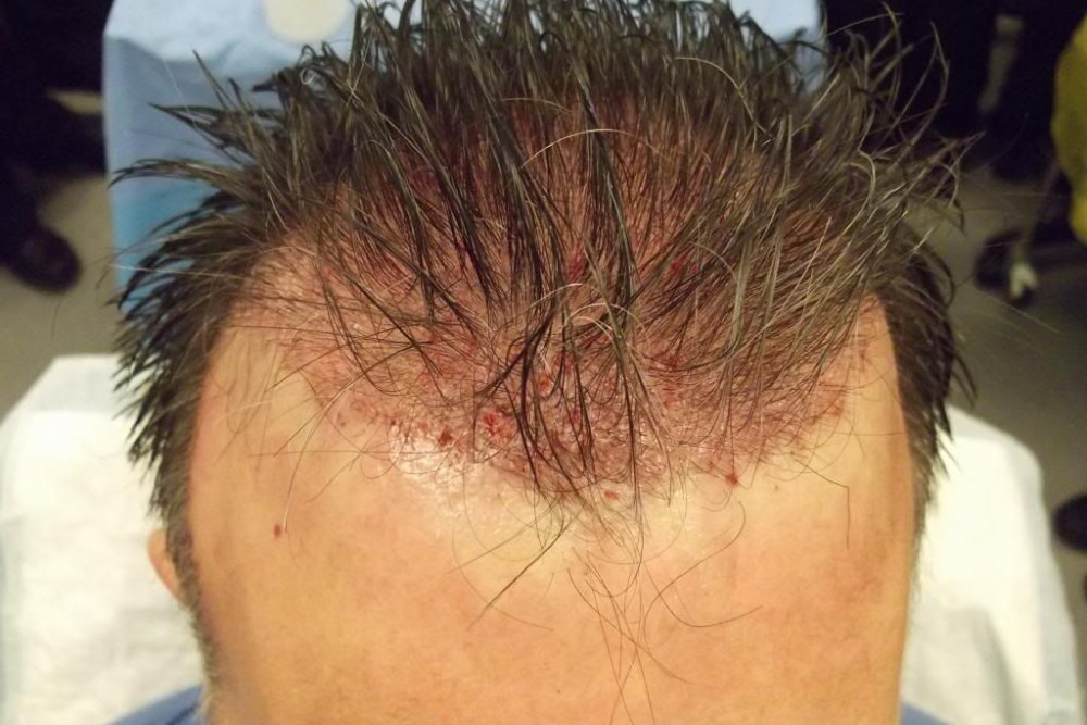 Mr. Edward Maitland Ball Hair Transplant 9.jpg