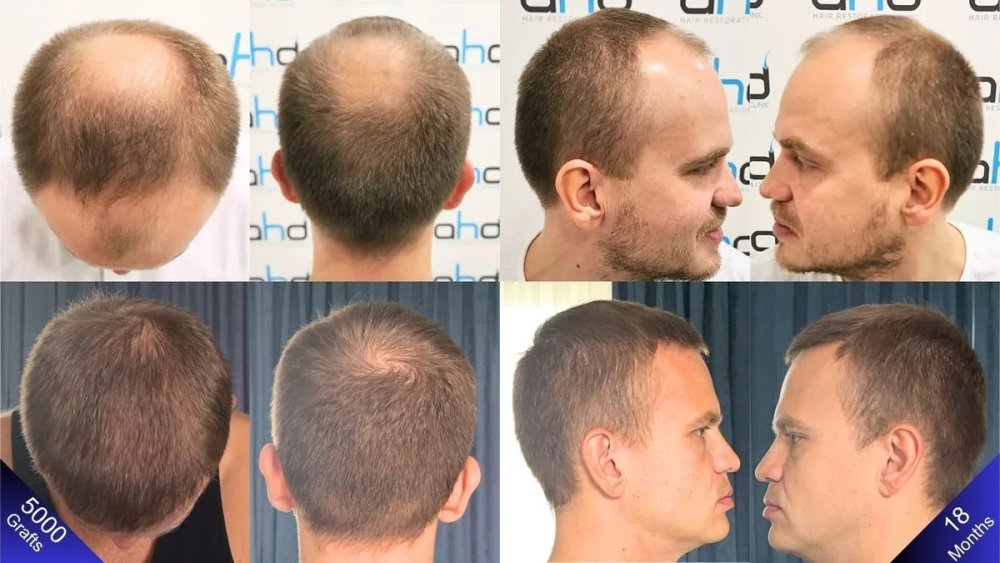 natural-hair-transplant-results.jpg
