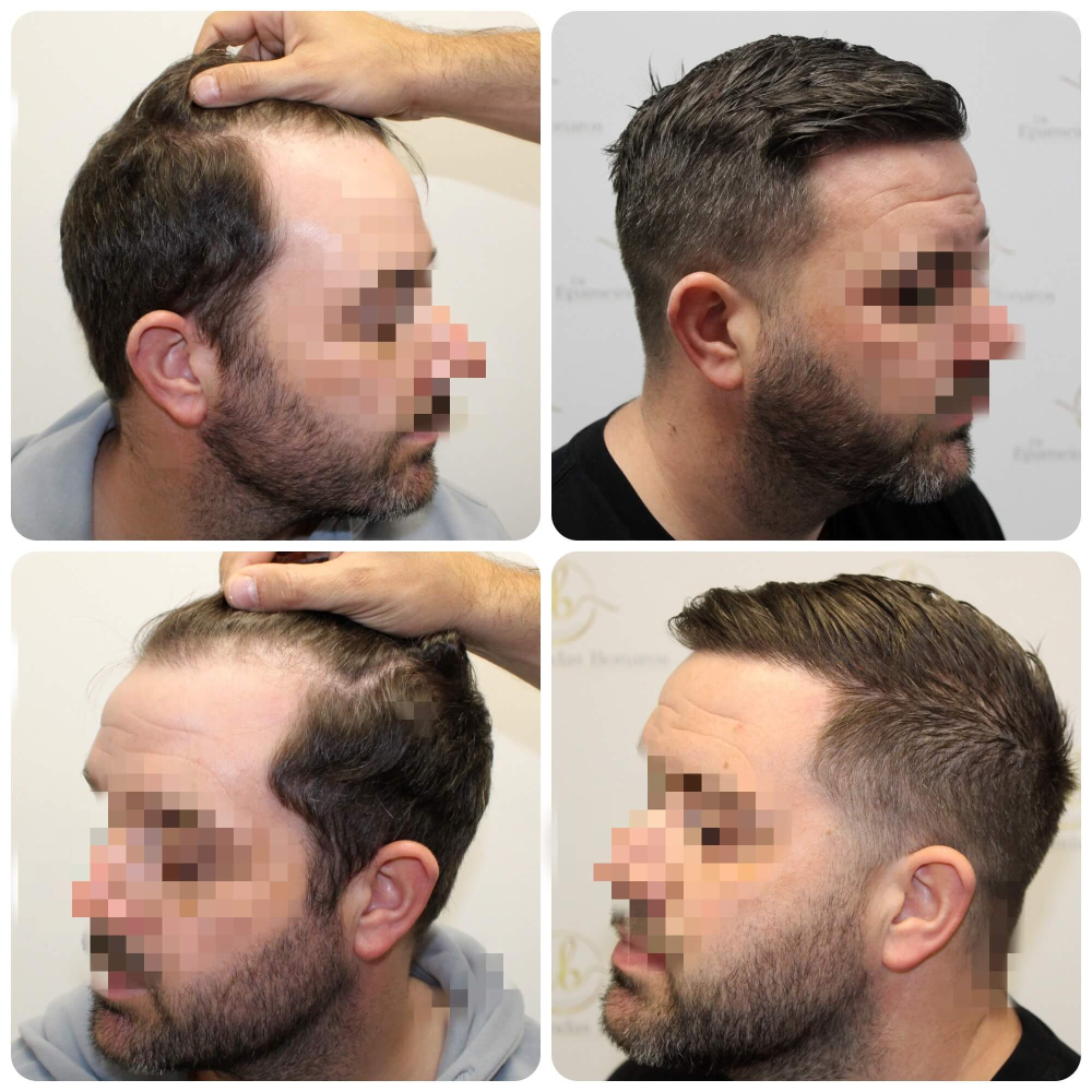 natural-hairline-hair-transplant.png