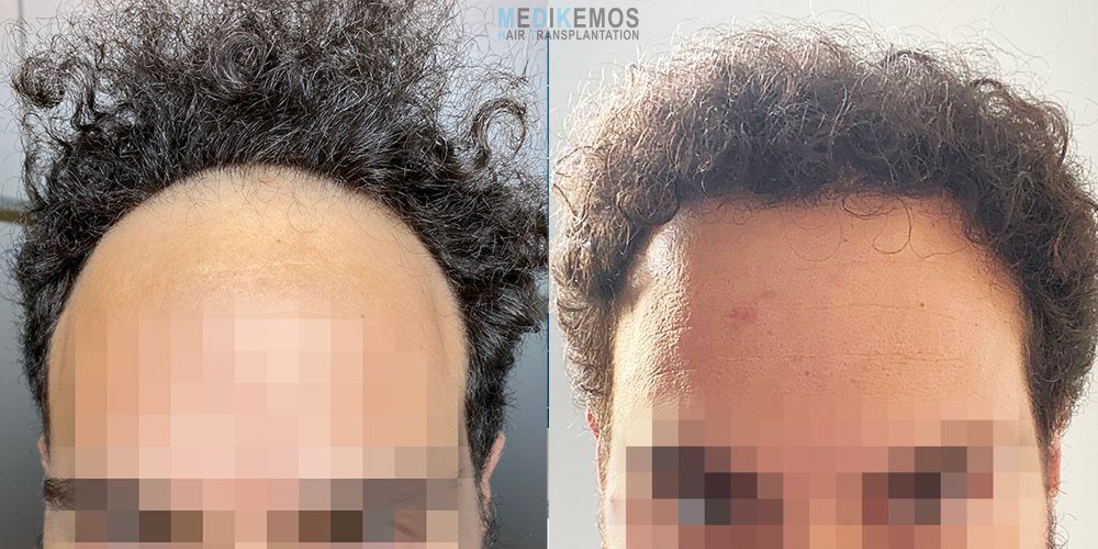 NM_11MONTHS-pre-post-X2-.jpg