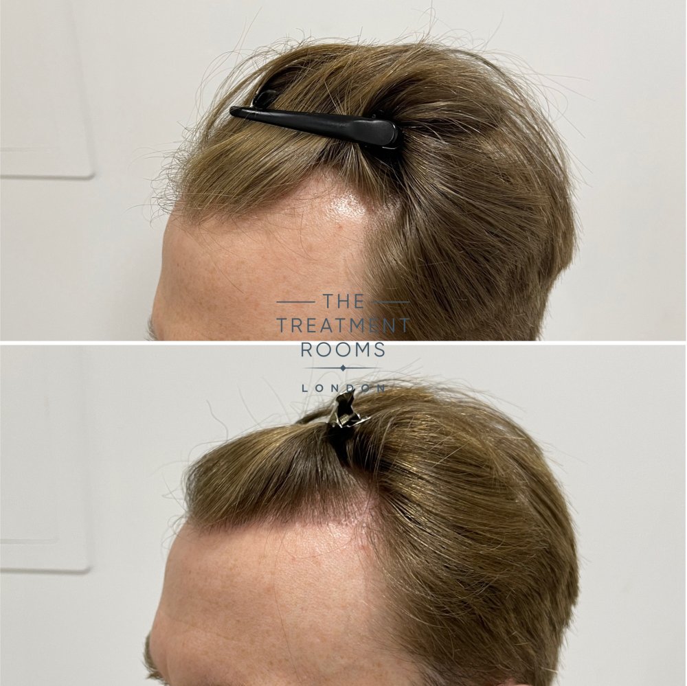 norwood 3 fue hair transplant before and after 1700 grafts.jpg