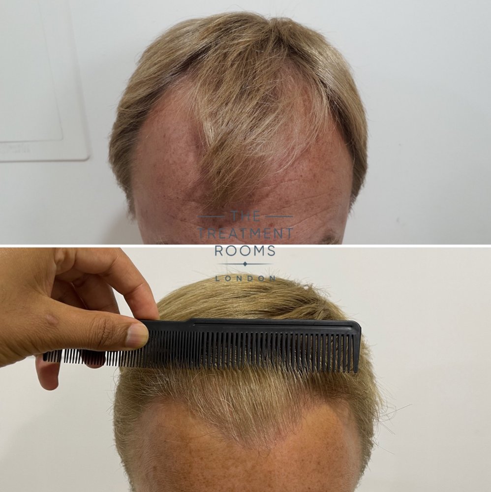 Norwood 3 FUE hair transplant before and after.jpg