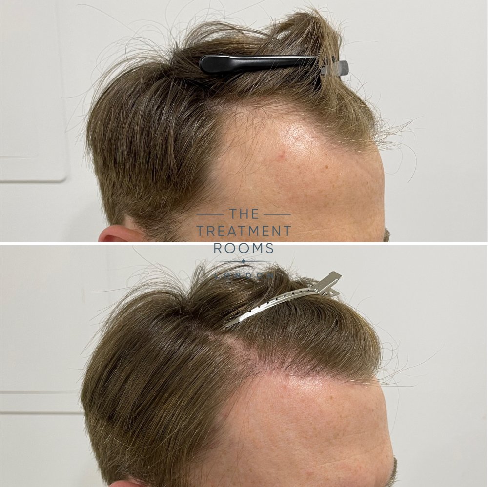 norwood 3 fue hair transplant result 1700 grafts.jpg