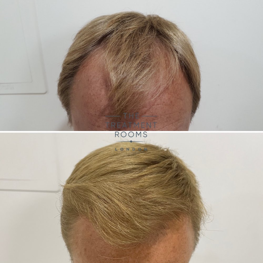 Norwood 3 FUE hair transplant result.jpg