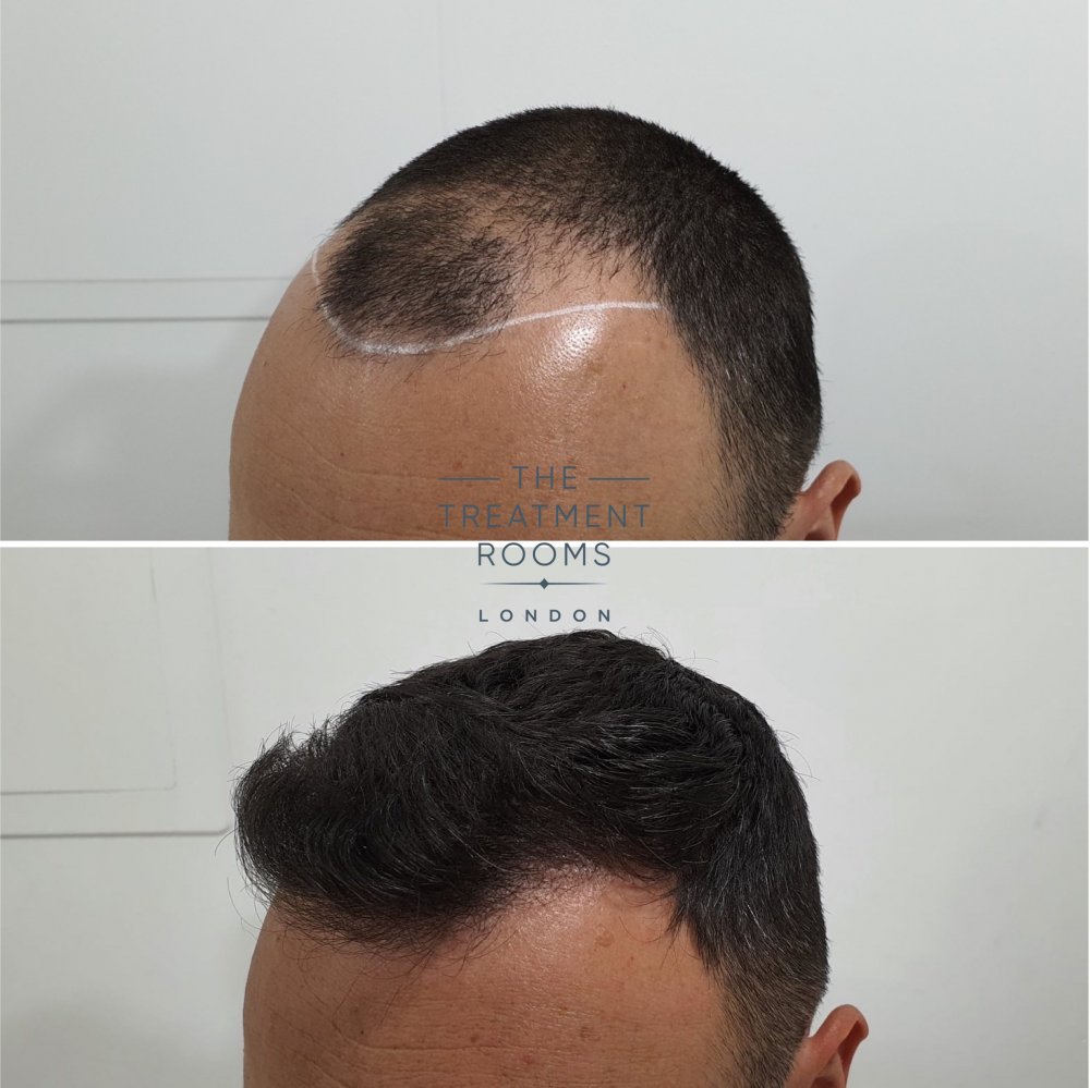 Norwood 4 FUE hair transplant before and after 1498 grafts.jpg
