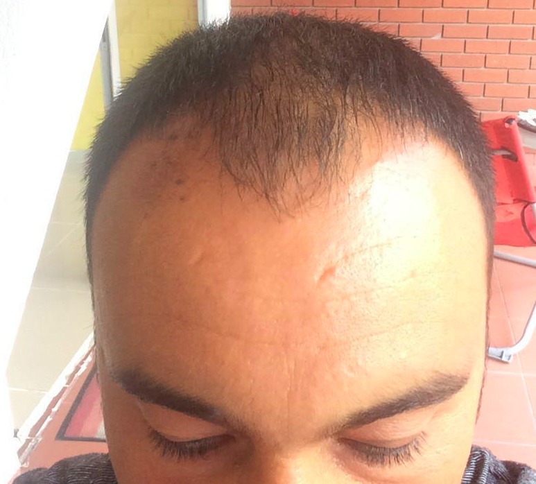 Post op 1.jpeg