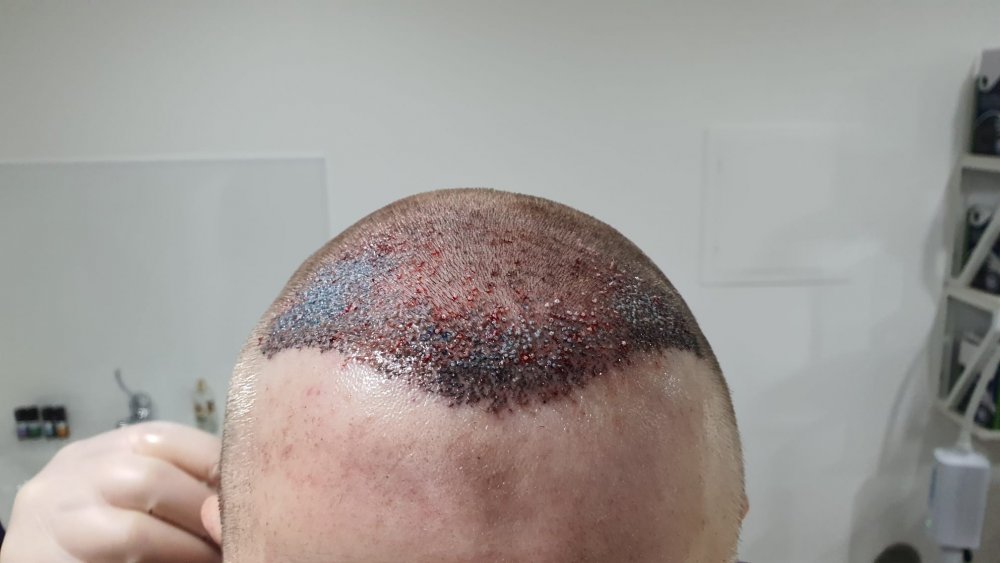 Post surgery 2.jpeg