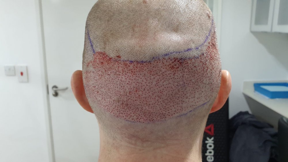 Post surgery 3.jpeg