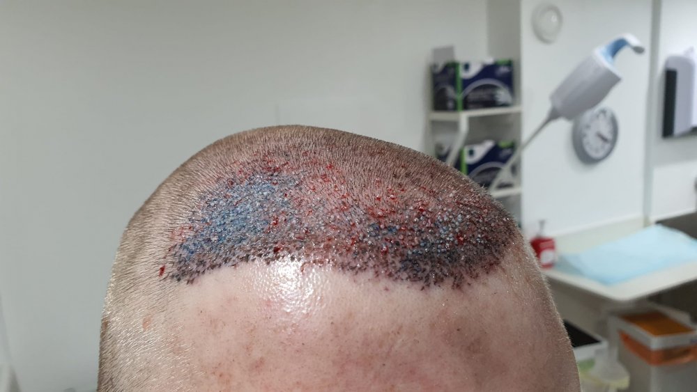 Post surgery 4.jpeg
