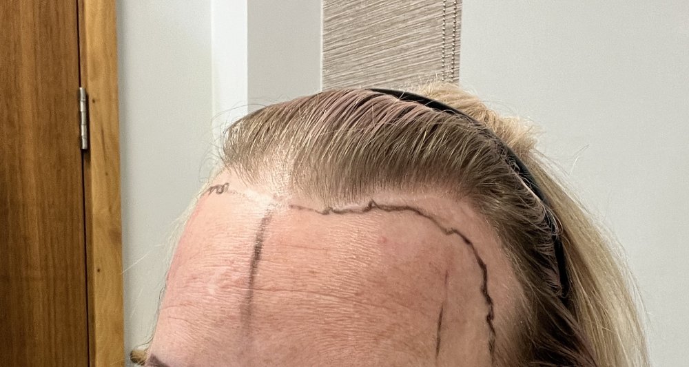 preop1.JPG