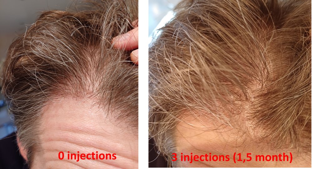 progress_decote_3injections.jpg