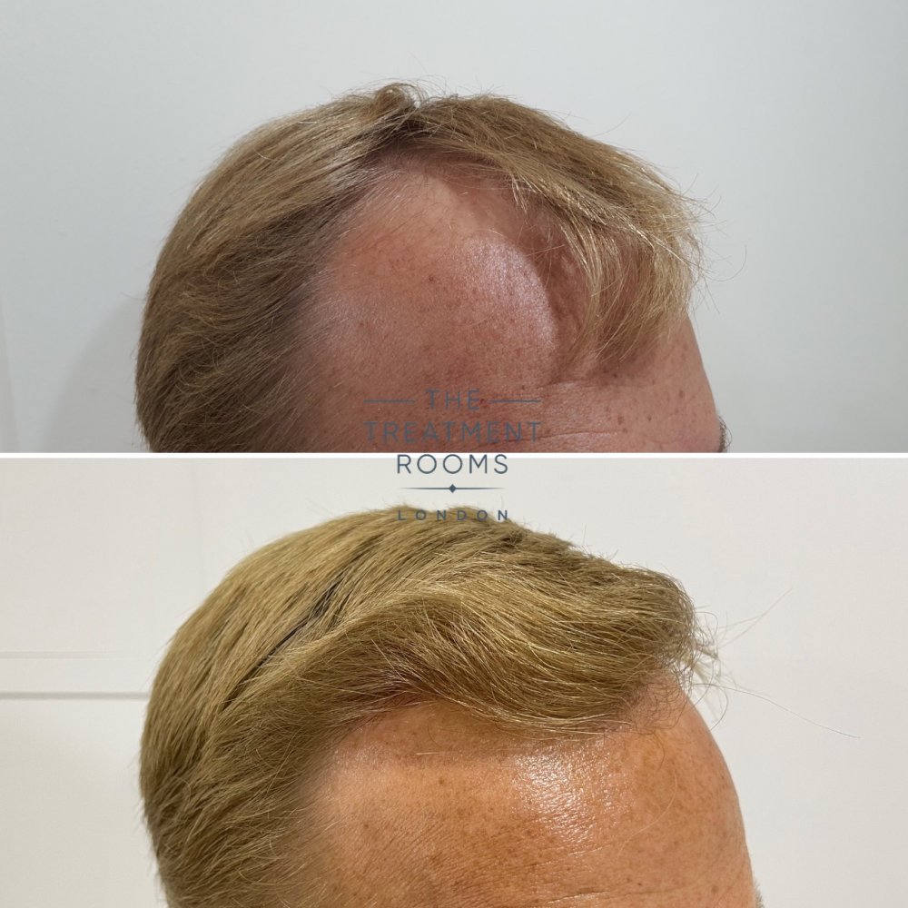 Receded hairline hair transplant before and after.jpg