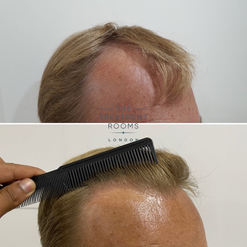 Receded hairline hair transplant detailed before and after.jpg